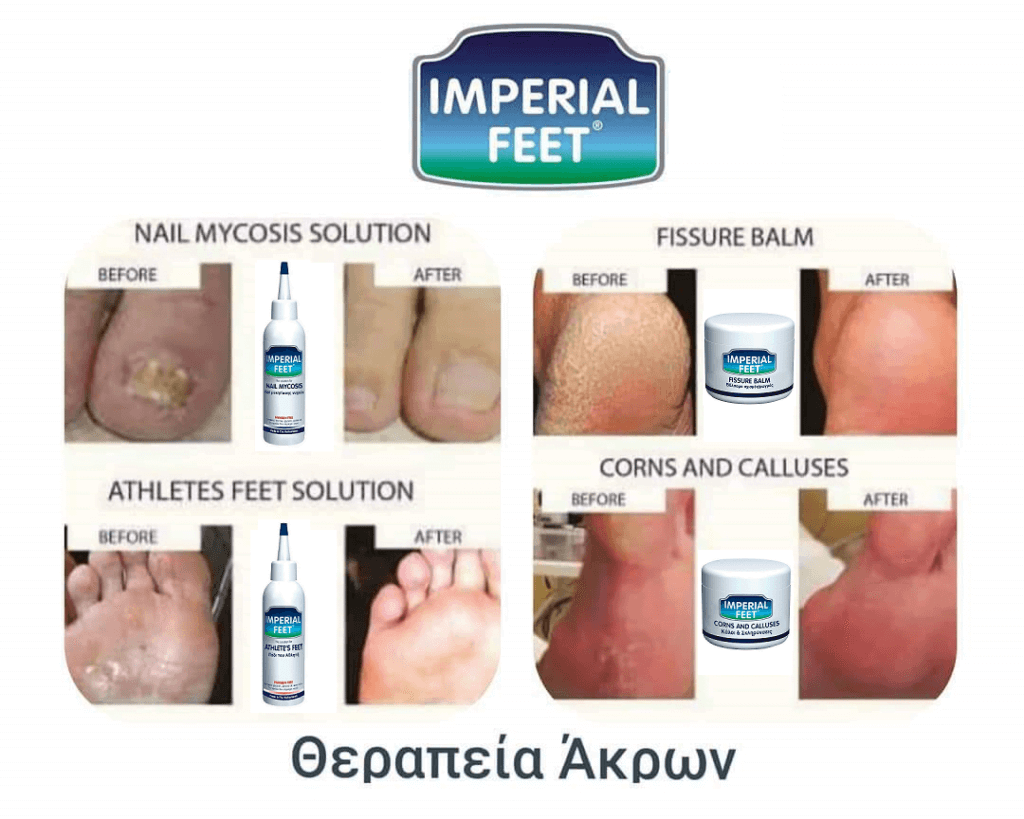 Αυτή η εικόνα δεν έχει ιδιότητα alt. Το όνομα του αρχείου είναι θεραπεία-ακρων-1024x819.png